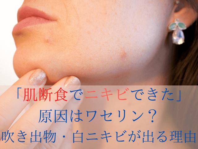 「肌断食でニキビできた」の原因はワセリン？吹き出物や白ニキビが出る理由を調査」